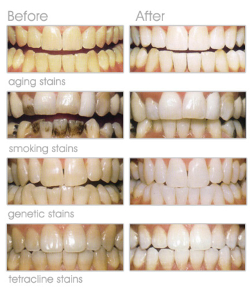 Dr. Goldie Dixit - Traitement de blanchiment des dents