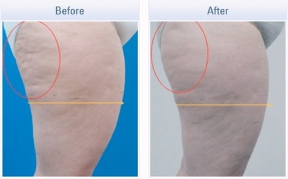 Definition Body & Face - Laser Treatments & Therapy
