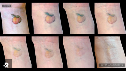 Removery Tattoo Removal & Fading - Détatouage laser