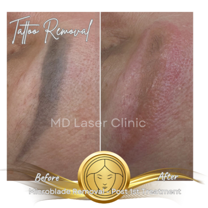 MD Laser Clinic - Épilation laser