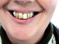 MyBite Kelowna - Denturists