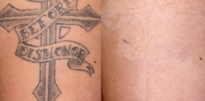 Amendermis Laser Clinic - Tattoo Removal - Laser Tattoo Removal