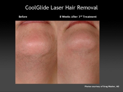 Oxford Laser Skin Solution - Traitement au laser