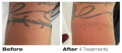 Precision Laser Tattoo Removal - Laser Tattoo Removal