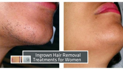 Orchid Laser Hair Removal - Laser Hair Removal