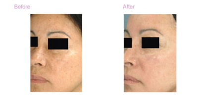 Ageless Beauty Laser - Laser Treatments & Therapy
