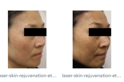 Julia Skin Beauty - Épilation laser