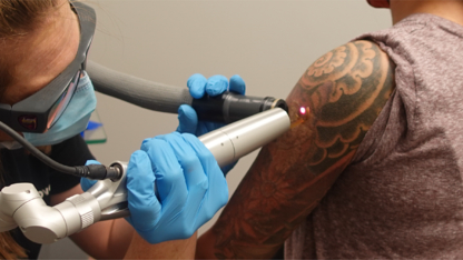 Removery Tattoo Removal & Fading - Détatouage laser