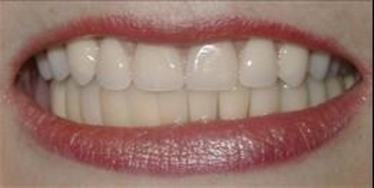 Papefinch Dental - Teeth Whitening Services