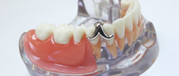 Gagnon Gaétan Denturologiste - Traitement de blanchiment des dents