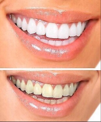 Blanchibec - Traitement de blanchiment des dents