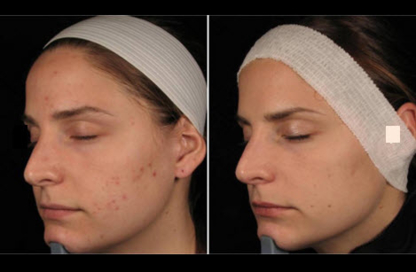 Rejuvenation Makeup and Laser Clinic - Traitement au laser