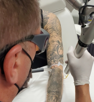 Unthink Inc. - Laser Tattoo Removal