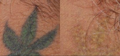 Amendermis Laser Clinic - Tattoo Removal