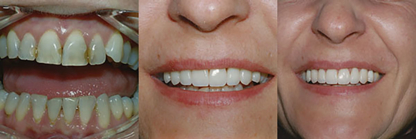 Woodcreek Dental Care - Teeth Whitening Services