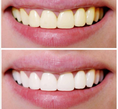 Gergana's Beauty & Teeth Whitening - Traitement de blanchiment des dents