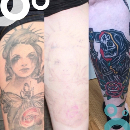 Removery Tattoo Removal & Fading - Détatouage laser