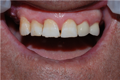 Brampton Dental Arts - Teeth Whitening Services