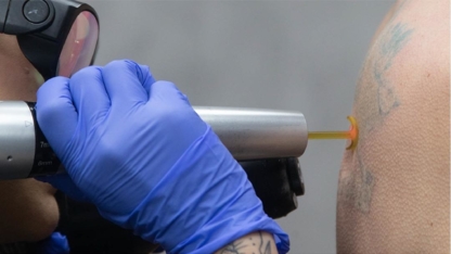 Removery Tattoo Removal & Fading - Laser Tattoo Removal