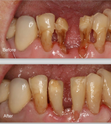 Highland Centre Dental Clinic - Traitement de blanchiment des dents