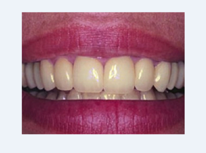 Centre Dentaire Limbour - Teeth Whitening Services