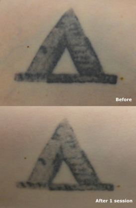 Tattoo Removal Canada - Laser Tattoo Removal