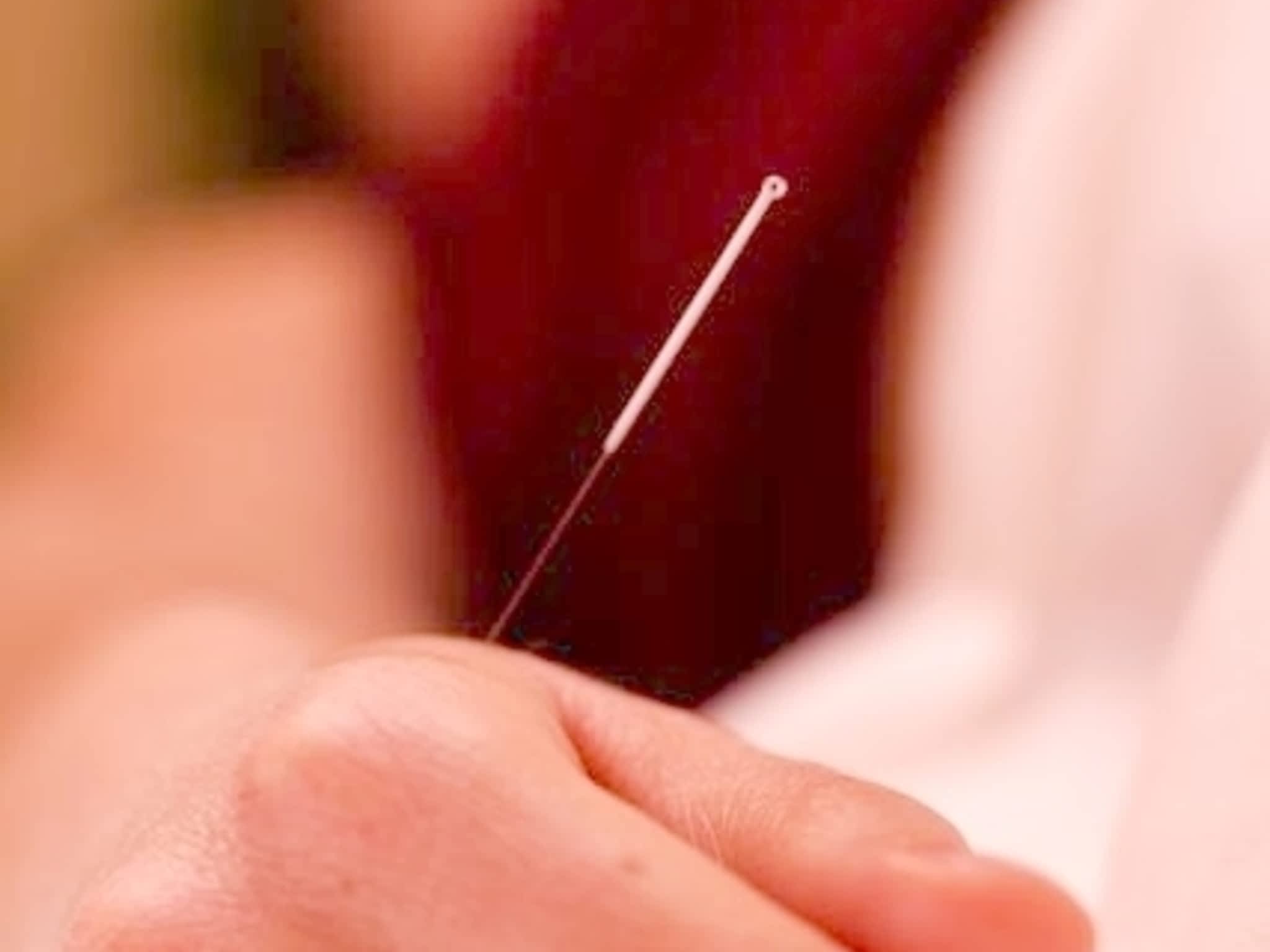 photo Acupuncture Sean Laflamme