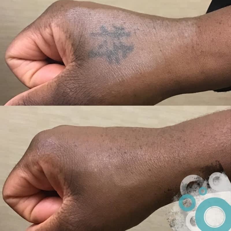 Tattoo Removal Wheeling WV  Breaking Skin Tattoo