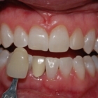 Abby Dental Care - Traitement de blanchiment des dents