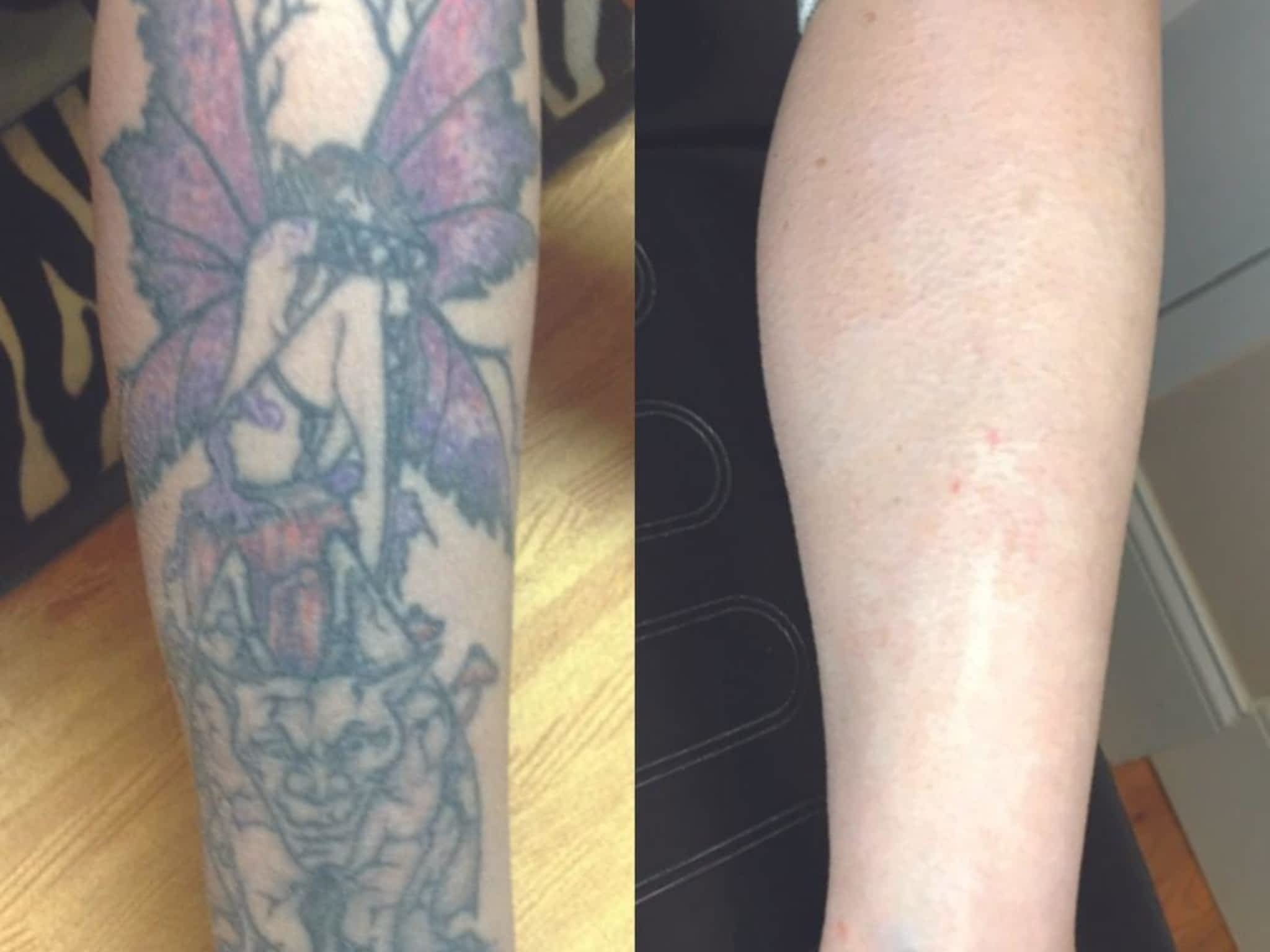 photo Removery Tattoo Removal & Fading