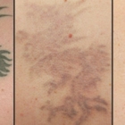 Tattoo Time Machine - Laser Tattoo Removal