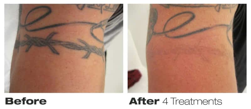 Precision Laser Tattoo Removal - Toronto, ON - 793 King St ...