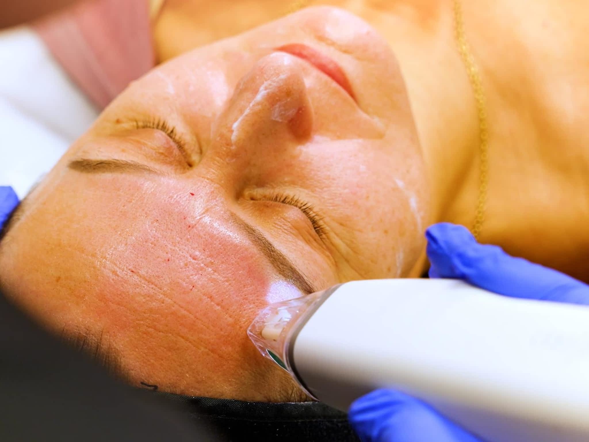 photo Ottawa Medical Spa And Aesthetic | Laser Hair Removal | Hydrafacials | RF Micro Needling | Chemical Peels | Botox