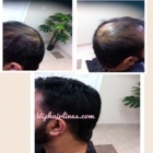 VIP Hairlines - Greffes de cheveux et remplacement capillaire