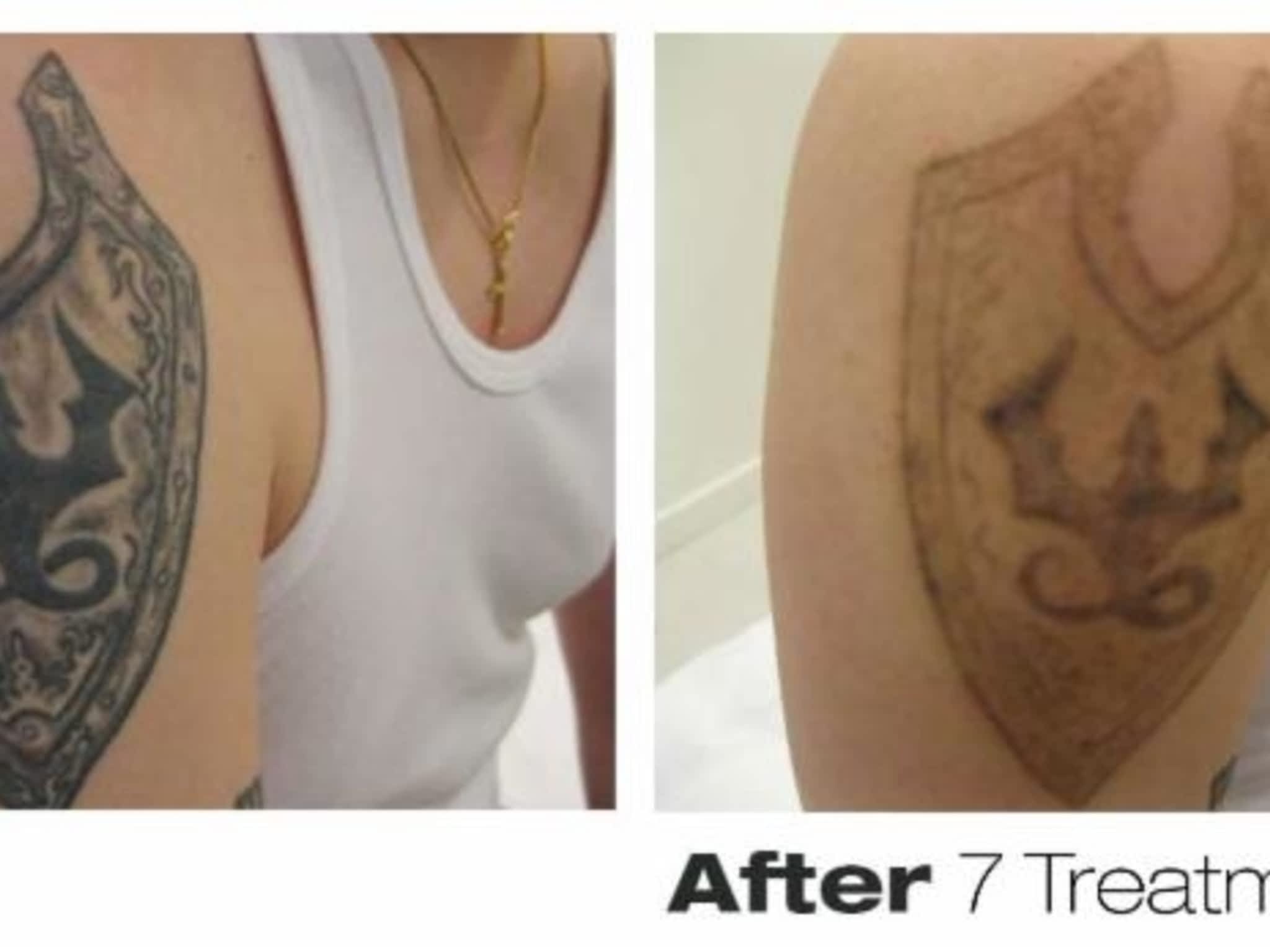 photo Precision Laser Tattoo Removal
