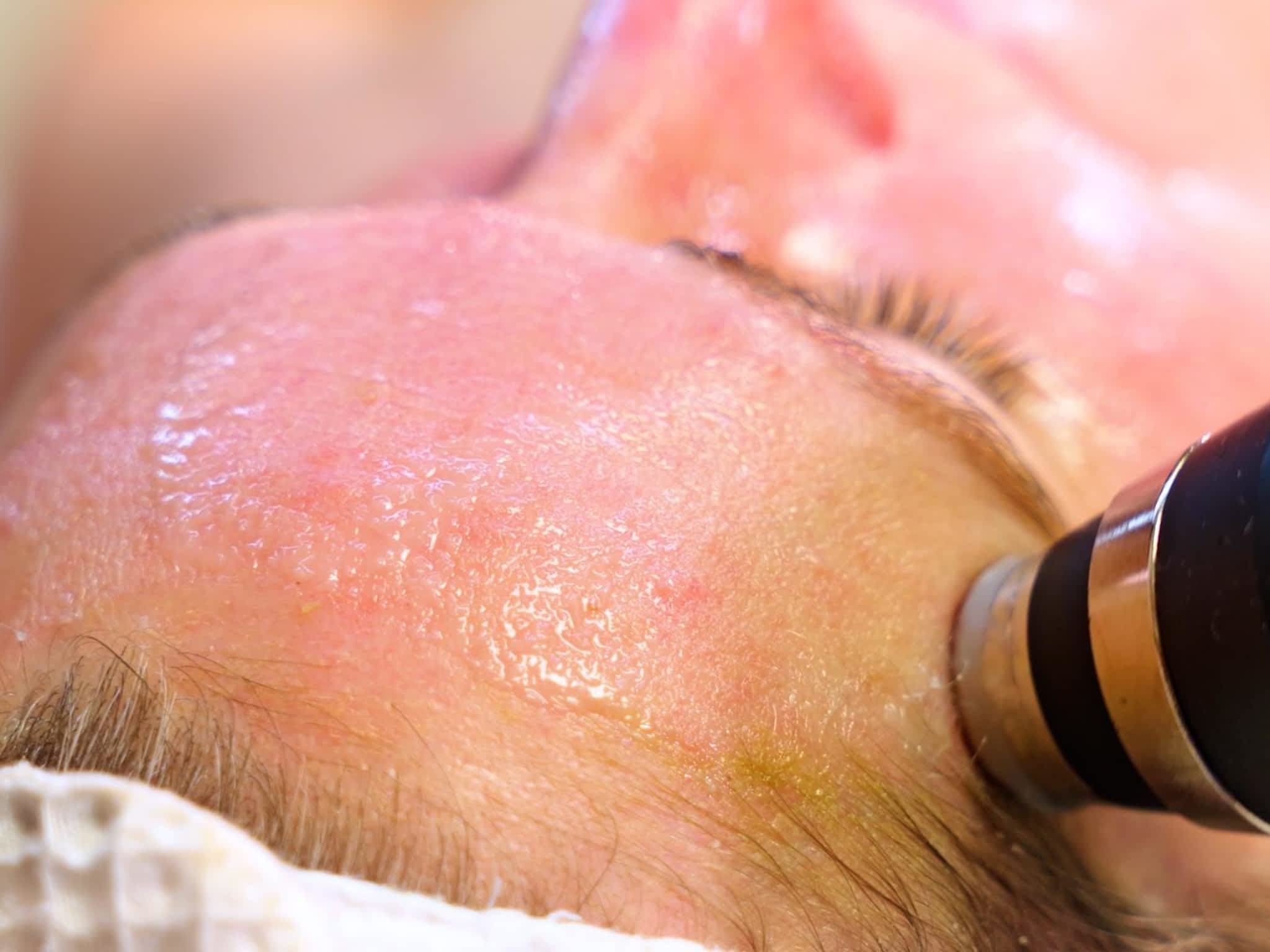 photo Ottawa Medical Spa And Aesthetic | Laser Hair Removal | Hydrafacials | RF Micro Needling | Chemical Peels | Botox