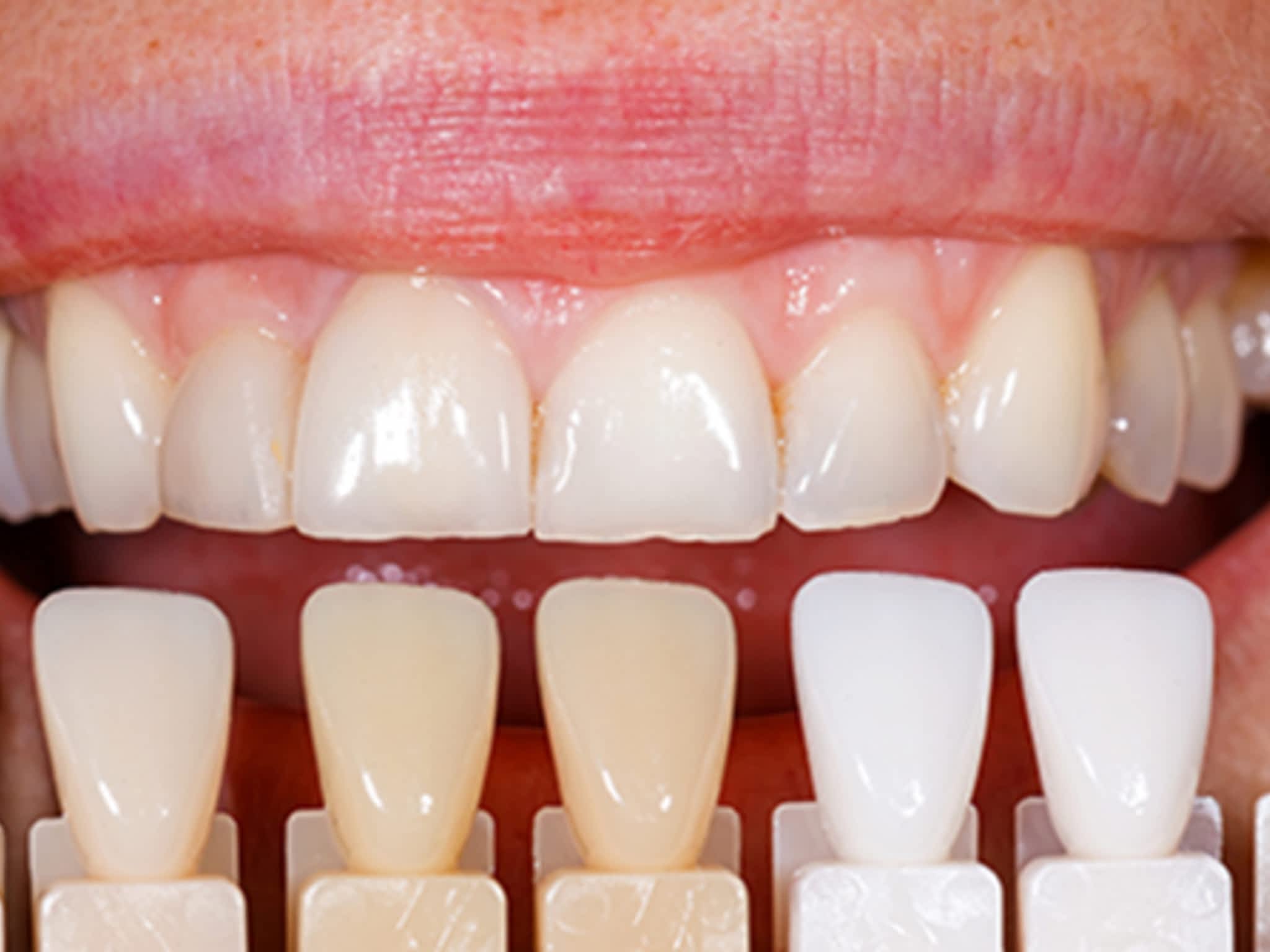 photo AdvancedWhite.ca - Professional Teeth Whitening Clinic