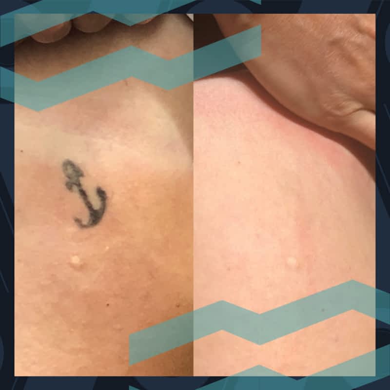Laser Tattoo Removal  Edmonton Dermatology  Nakatsui DermaSurgery