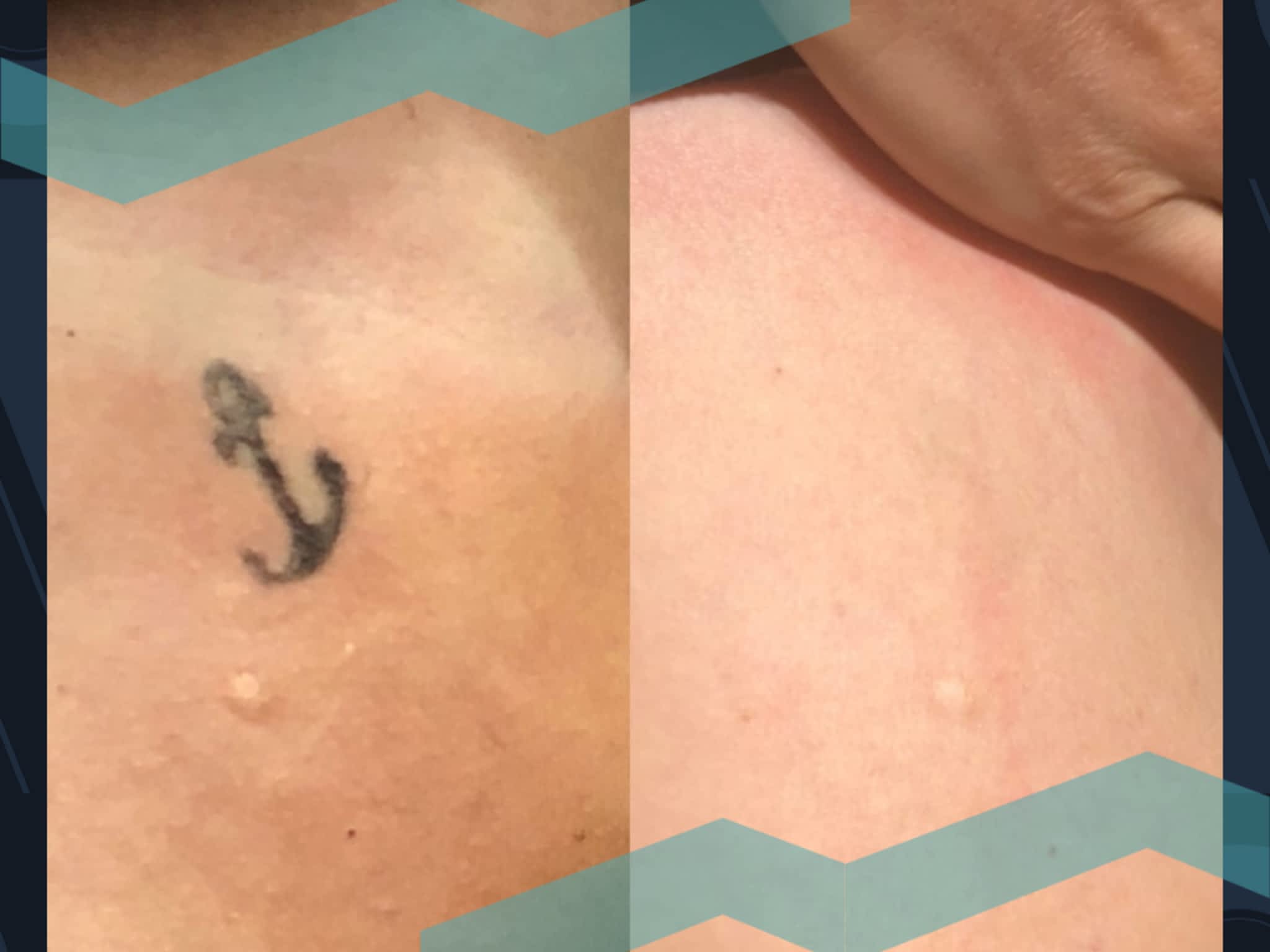 photo Removery Tattoo Removal & Fading