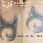 Restoration Tattoo Removal - Détatouage laser