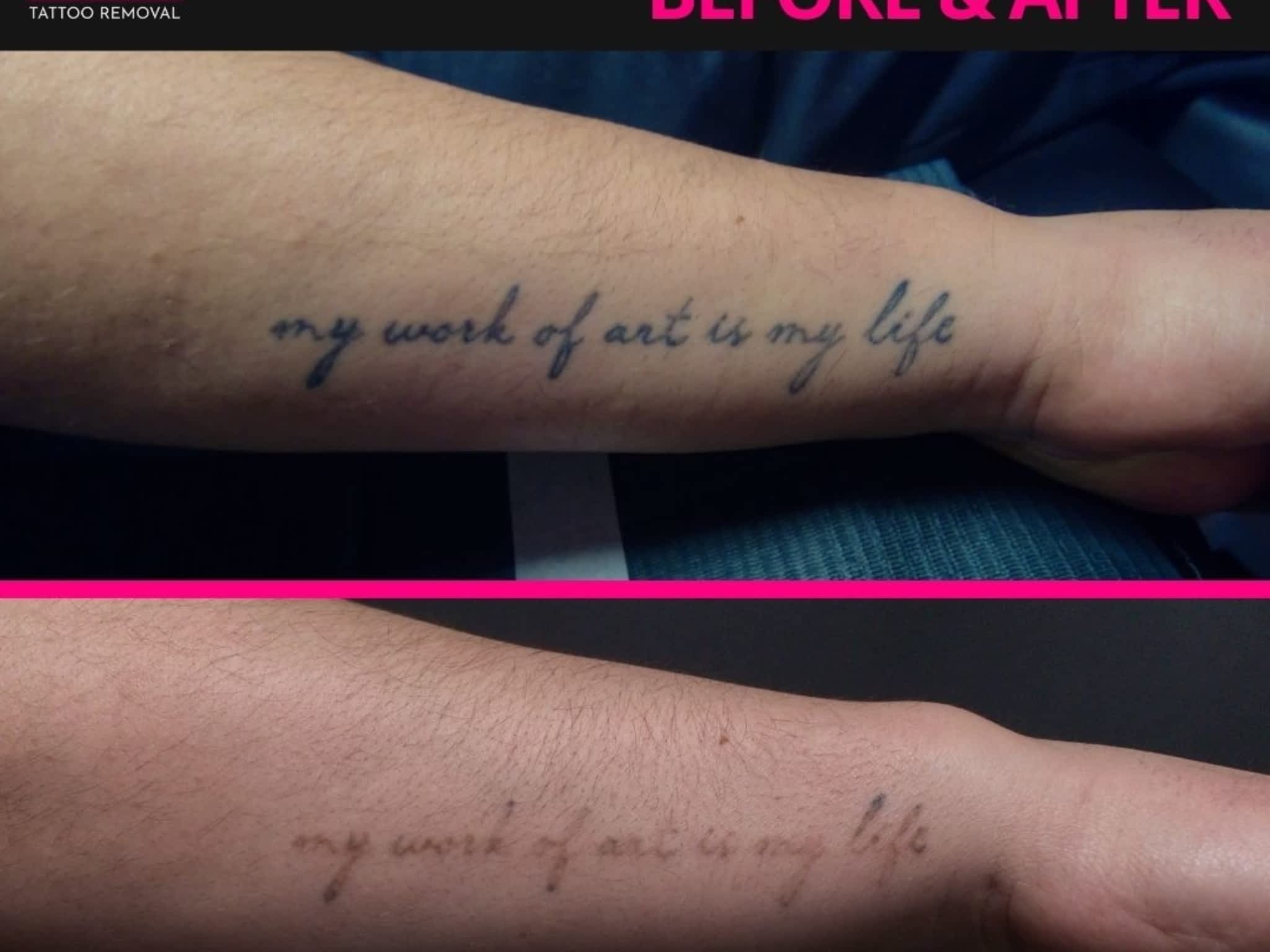 photo Legacy Tattoo Removal Limited