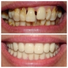 North York Smile Centre - Teeth Whitening Services