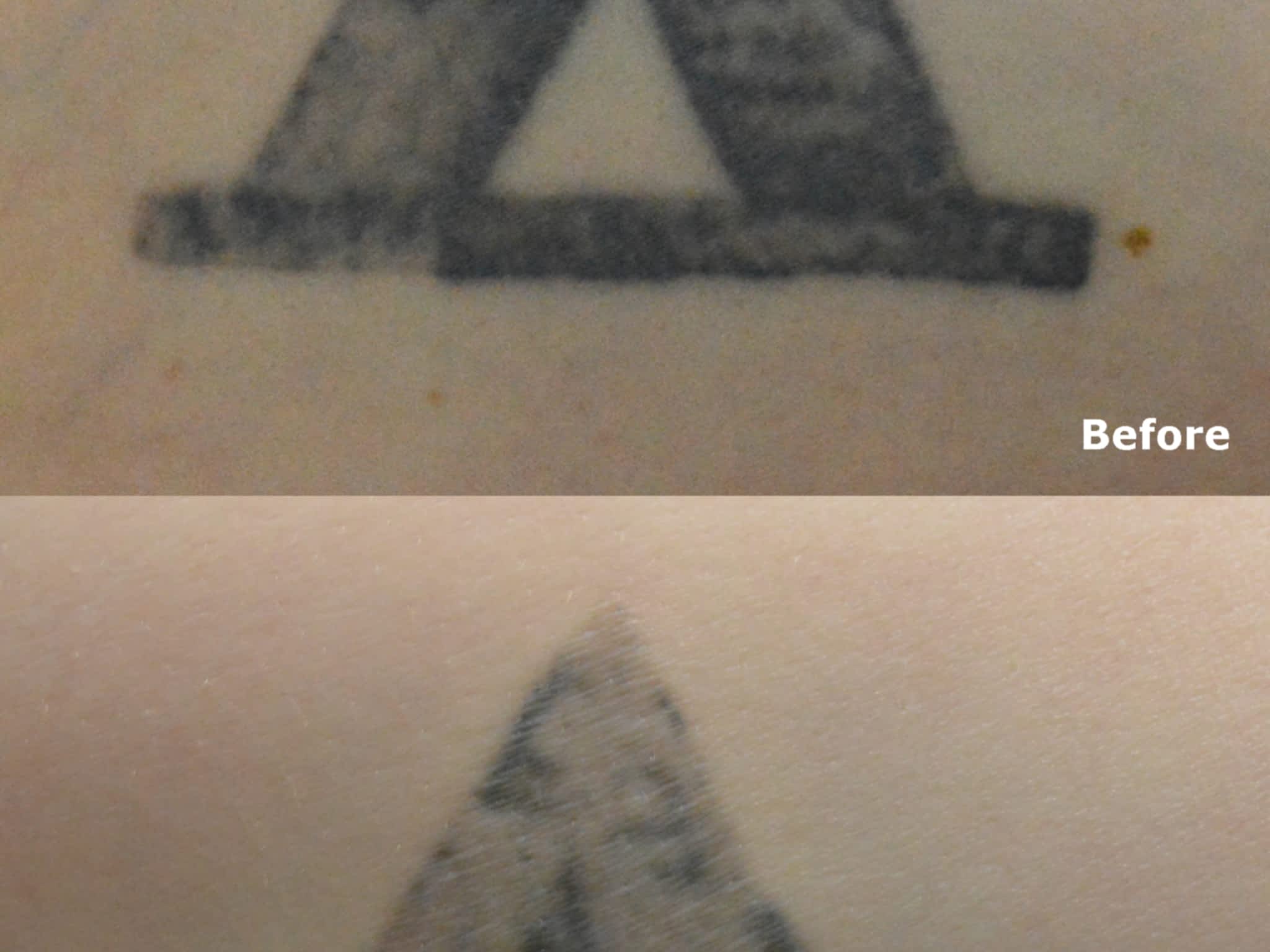 photo Tattoo Removal Canada