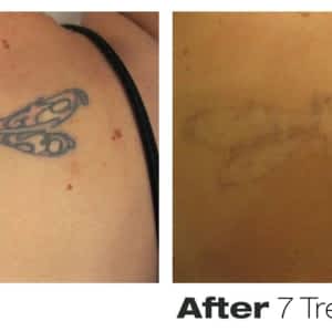 precision laser tattoo removal opening hours 76 richmond st e precision laser tattoo removal opening hours 76 richmond st e